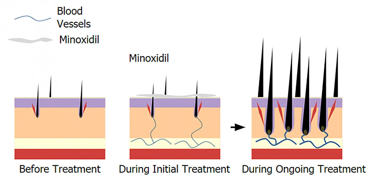 minoxidil works for hair mobelbio minoxidil works for hair mobelbio